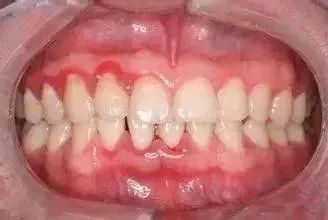 牙齦出現膿包，係咩嘢情況？